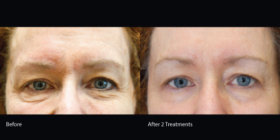 exilis tightening tighten deposits fatty hyperpigmentation