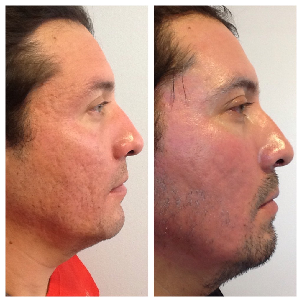 Fractional CO2 Laser Rental to Treat Ance Scars and Sun Damage
