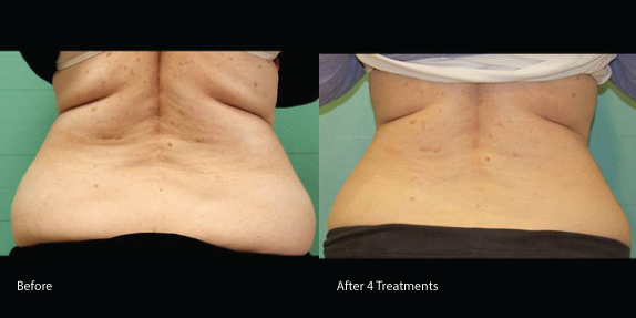 The Ideal Exilis Body Contouring Patient - Los Angeles Laser Rental