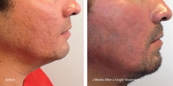 Acne-Scars-CO2-B&A-labled
